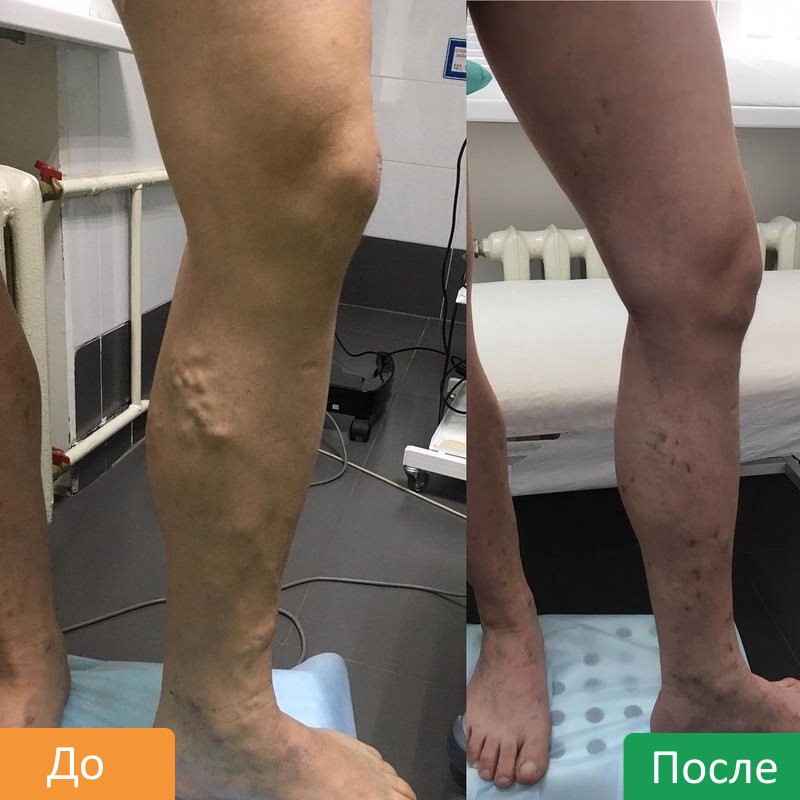RChA-ven-nizhnih-konechnostej-1