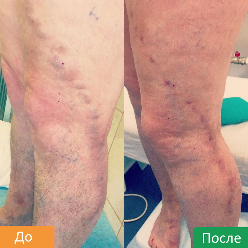 RChA-ven-nizhnih-konechnostej-11 (1)