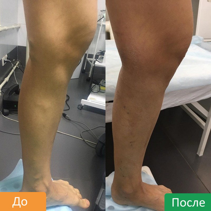 RChA-ven-nizhnih-konechnostej-2