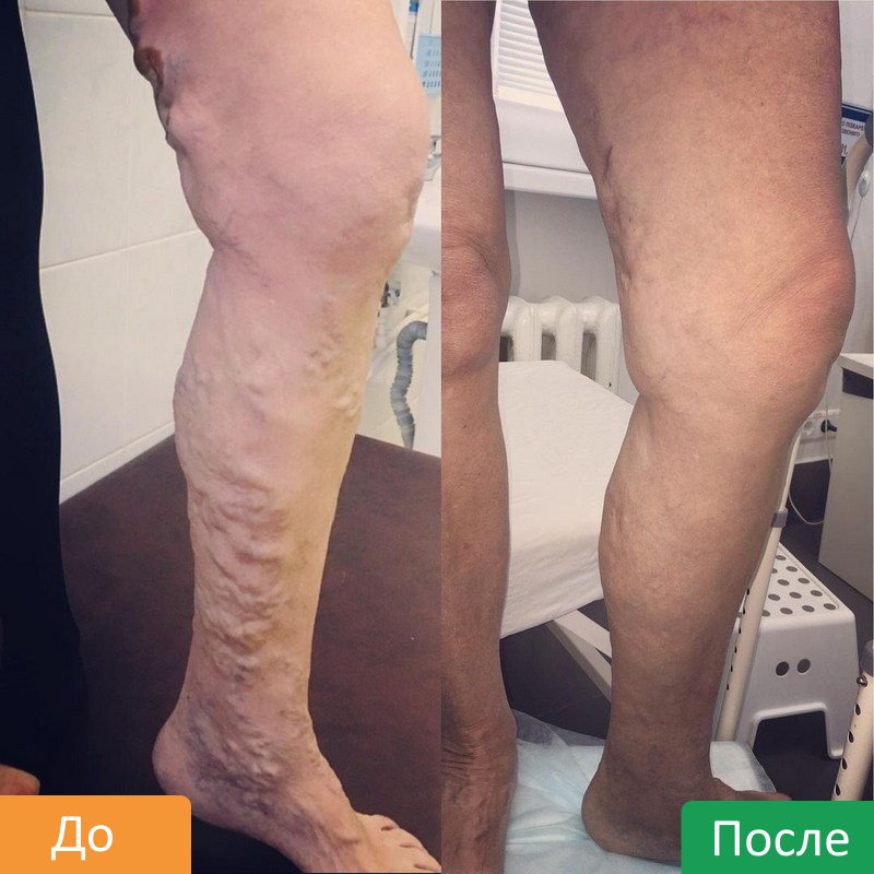 RChA-ven-nizhnih-konechnostej-6 (1)