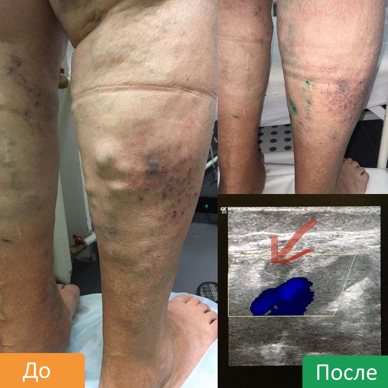 RChA-ven-nizhnih-konechnostej-7
